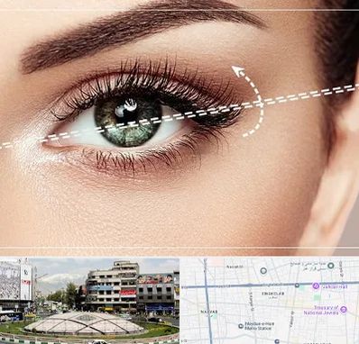 جراحی چشم گربه ای در مرکز تهران