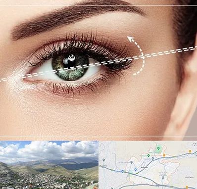 جراحی چشم گربه ای در رودهن