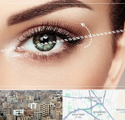 جراحی چشم گربه ای در جنوب شرق تهران