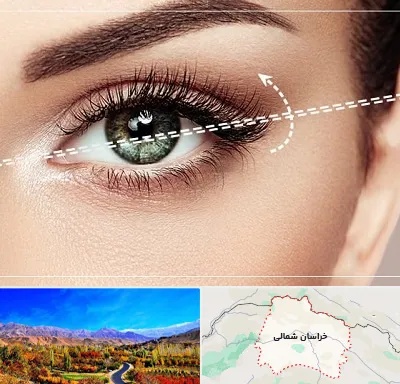 جراحی چشم گربه ای در خراسان شمالی