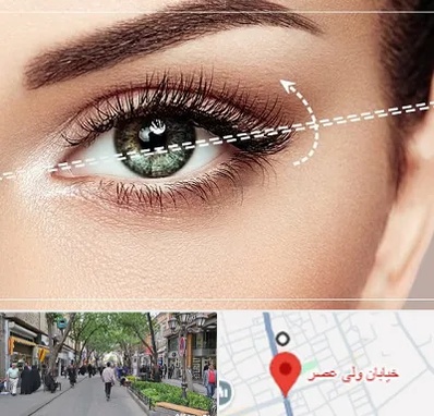 جراحی چشم گربه ای در ولیعصر شهریار