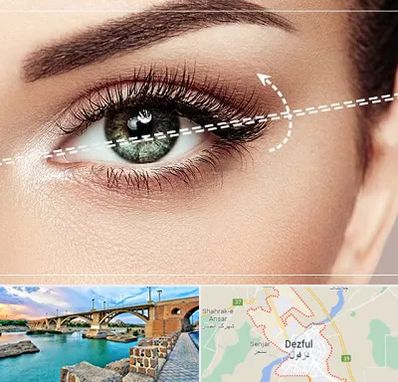 جراحی چشم گربه ای در دزفول