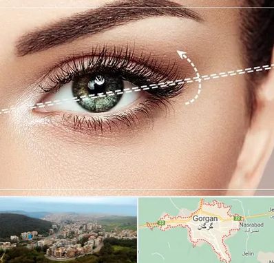 جراحی چشم گربه ای در گرگان