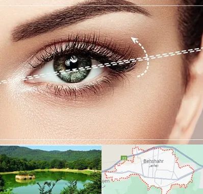 جراحی چشم گربه ای در بهشهر