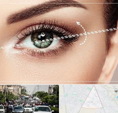 جراحی چشم گربه ای در سیدی مشهد