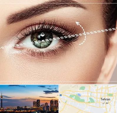 جراحی چشم گربه ای در غرب تهران 