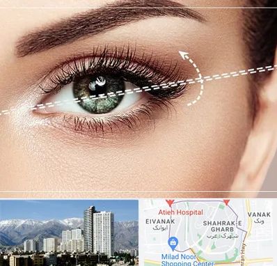 جراحی چشم گربه ای در شهرک غرب 