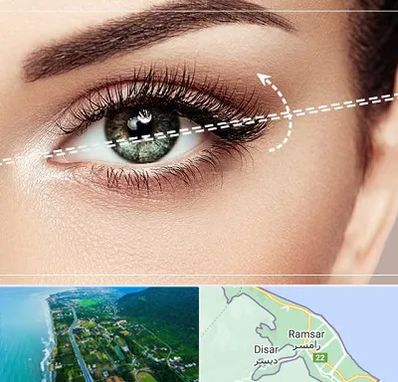 جراحی چشم گربه ای در رامسر