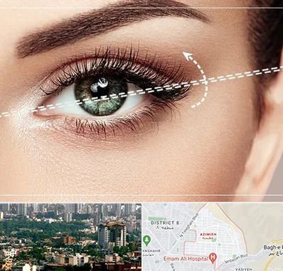 جراحی چشم گربه ای در عظیمیه کرج 