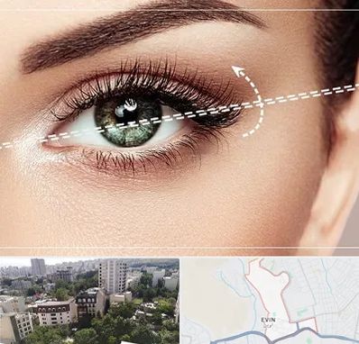 جراحی چشم گربه ای در اوین