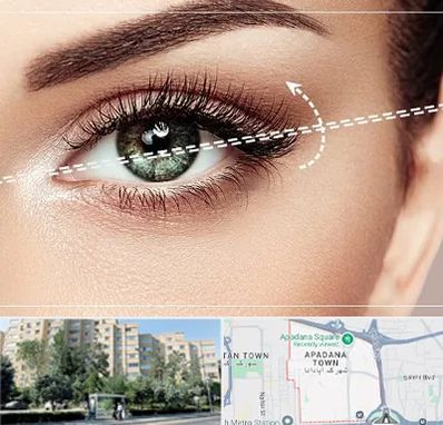 جراحی چشم گربه ای در آپادانا