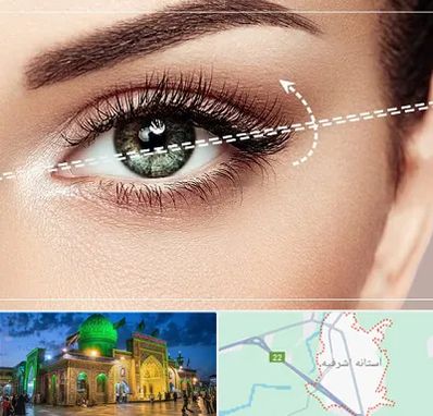 جراحی چشم گربه ای در آستانه اشرفیه