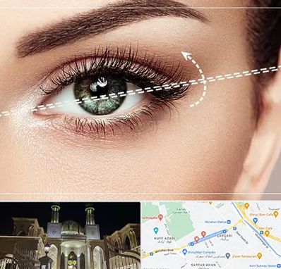 جراحی چشم گربه ای در زرگری شیراز