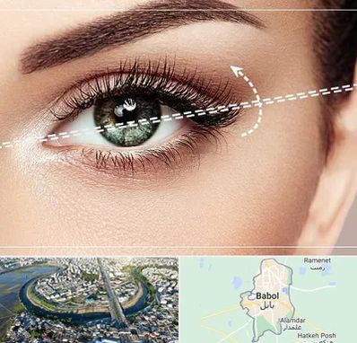 جراحی چشم گربه ای در بابل