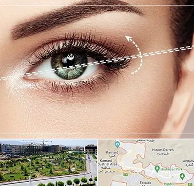 جراحی چشم گربه ای در پردیس