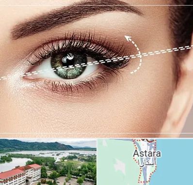 جراحی چشم گربه ای در آستارا