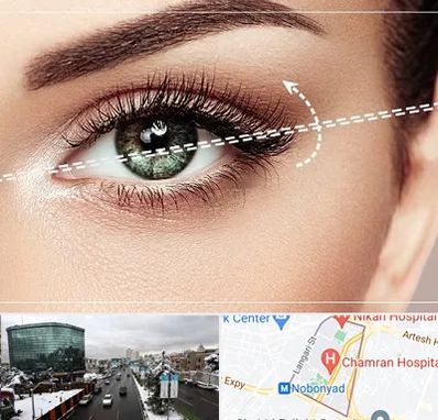 جراحی چشم گربه ای در اقدسیه 