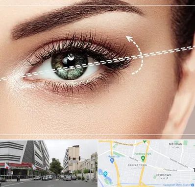 جراحی چشم گربه ای در بلوار فردوس 