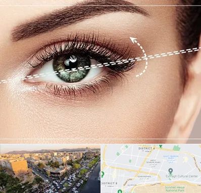 جراحی چشم گربه ای در تهرانپارس 