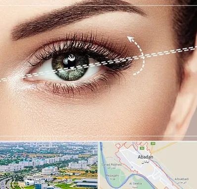 جراحی چشم گربه ای در آبادان