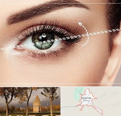 جراحی چشم گربه ای در تویسرکان