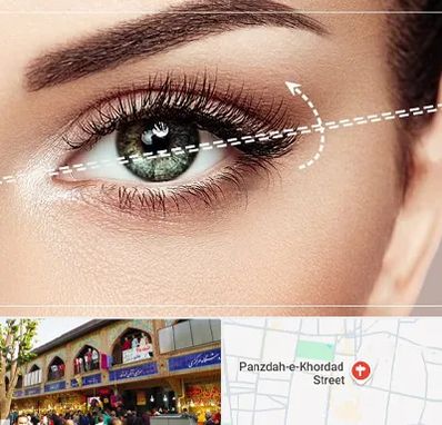 جراحی چشم گربه ای در 15 خرداد