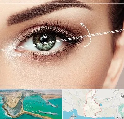 جراحی چشم گربه ای در سیستان و بلوچستان