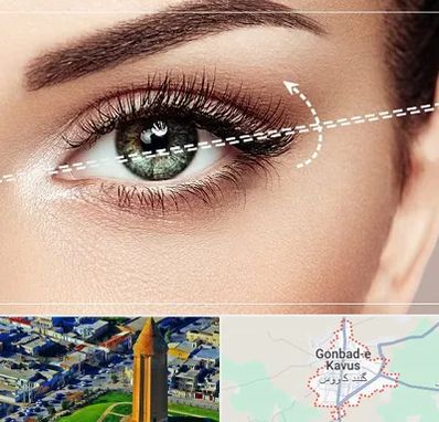 جراحی چشم گربه ای در گنبد کاووس