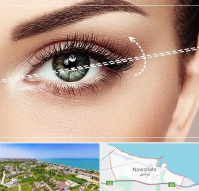 جراحی چشم گربه ای در نوشهر