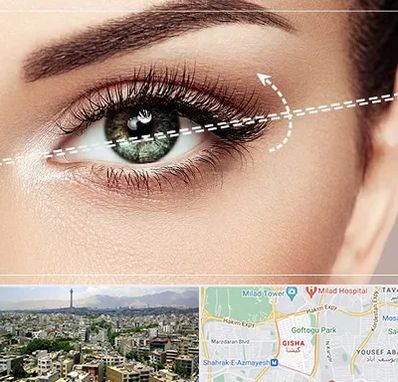 جراحی چشم گربه ای در گیشا 