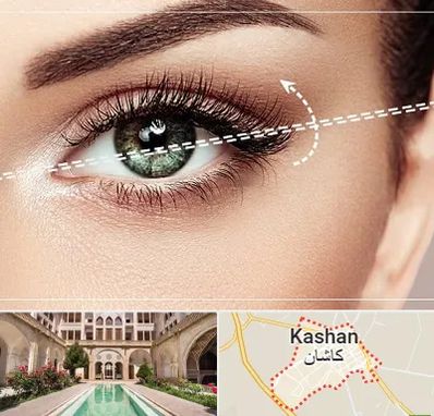 جراحی چشم گربه ای در کاشان