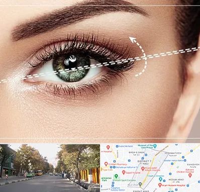 جراحی چشم گربه ای در شریعتی 