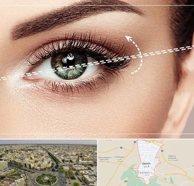 جراحی چشم گربه ای در قزوین