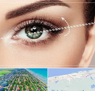 جراحی چشم گربه ای در فریدونکنار