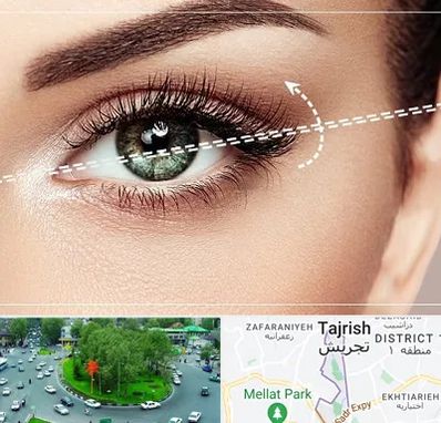 جراحی چشم گربه ای در تجریش 