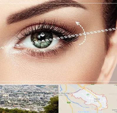 جراحی چشم گربه ای در یاسوج