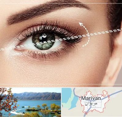 جراحی چشم گربه ای در مریوان