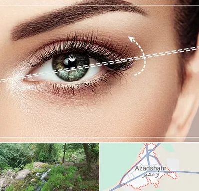 جراحی چشم گربه ای در آزادشهر