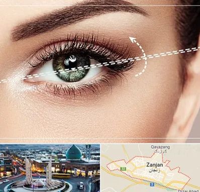 جراحی چشم گربه ای در زنجان