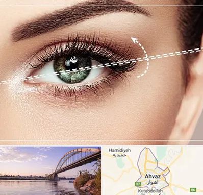 جراحی چشم گربه ای در اهواز