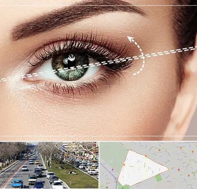 جراحی چشم گربه ای در احمدآباد مشهد 