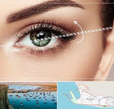 جراحی چشم گربه ای در چابهار