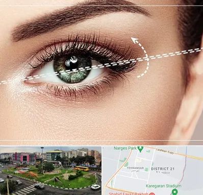 جراحی چشم گربه ای در تهرانسر 