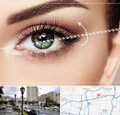 جراحی چشم گربه ای در شمال غرب تهران