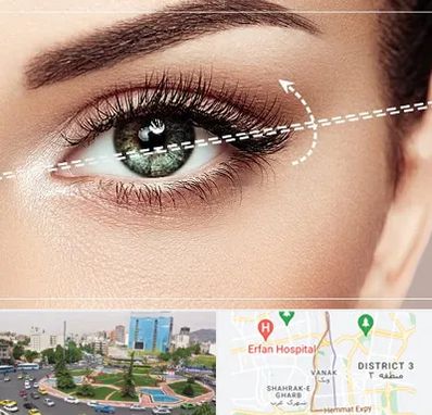 جراحی چشم گربه ای در ونک 