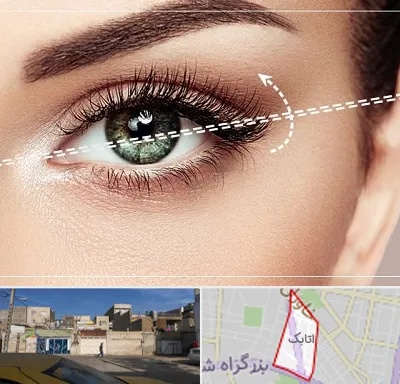جراحی چشم گربه ای در اتابک