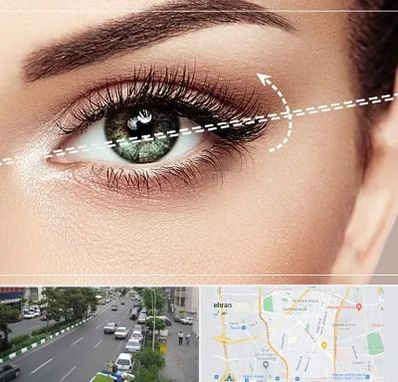 جراحی چشم گربه ای در ستارخان 