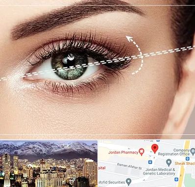 جراحی چشم گربه ای در جردن 