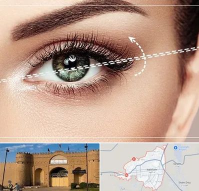 جراحی چشم گربه ای در ایرانشهر
