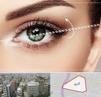 جراحی چشم گربه ای در آذری